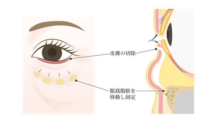 経皮的眼窩脂肪移動術(表ハムラ)