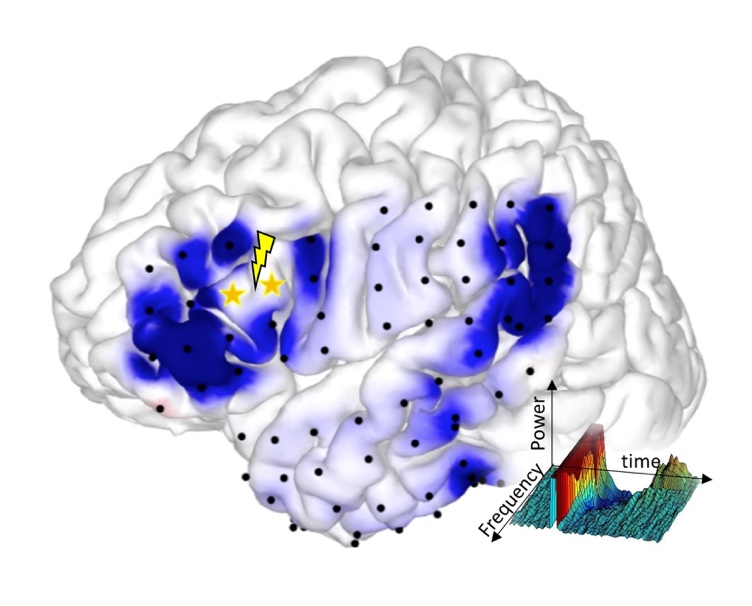 皮質皮質間誘発電位（cortico-cortical evoked potential）による言語ネットワークの可視化