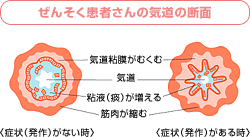 ぜんそく患者さんの気道の断面