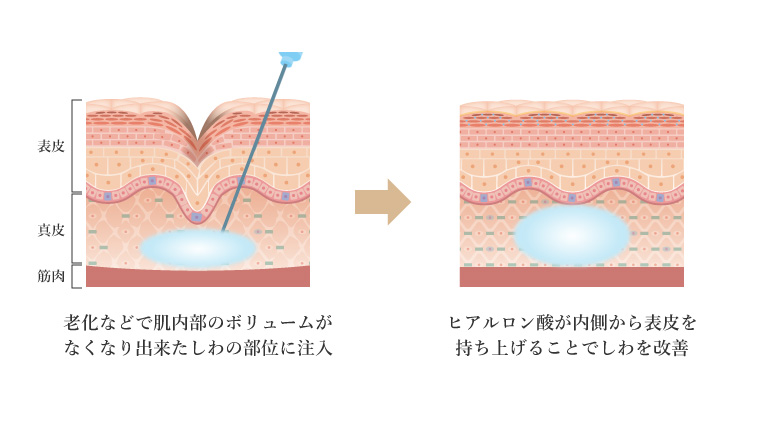 ヒアルロン酸注入