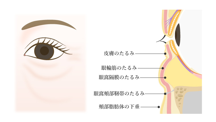 下まぶたの老化