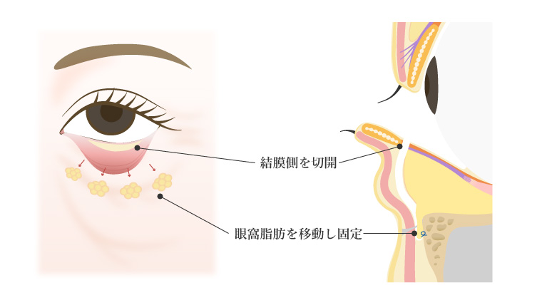 経結膜的眼窩脂肪移動術(裏ハムラ)