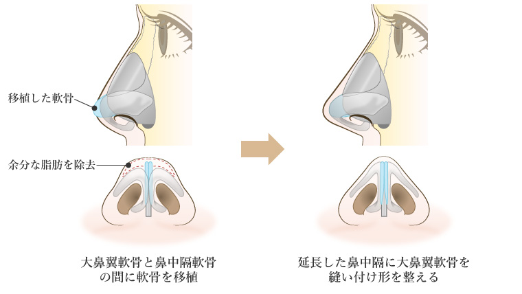 鼻中隔延長術