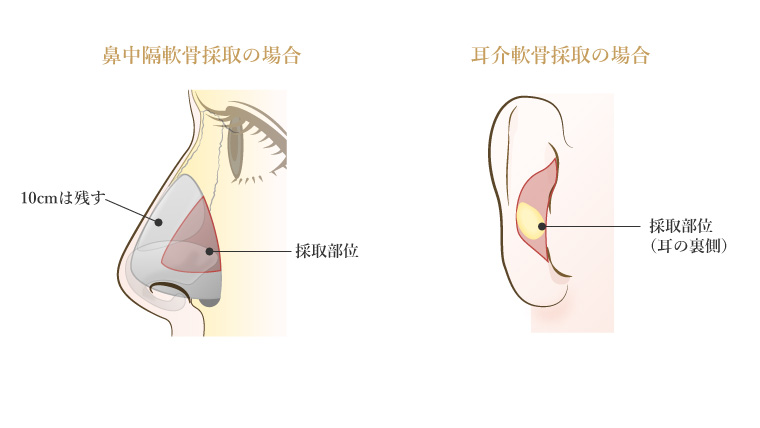 鼻中隔延長術の問題点