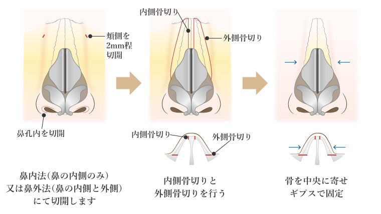 鼻骨骨切り