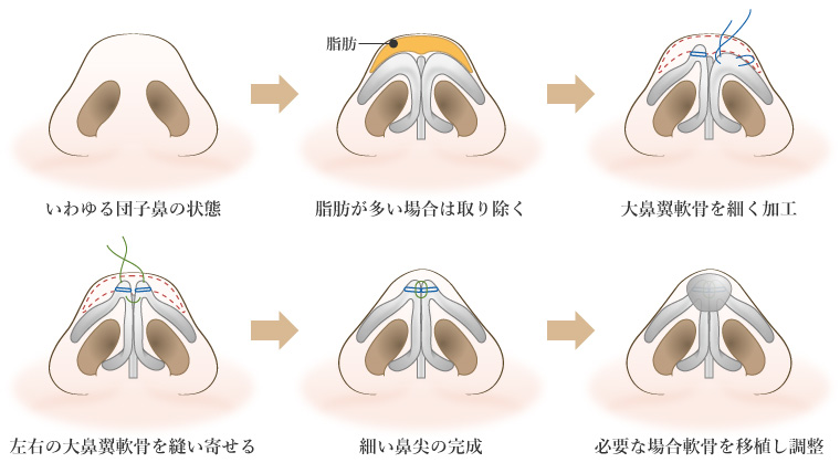 鼻尖形成術