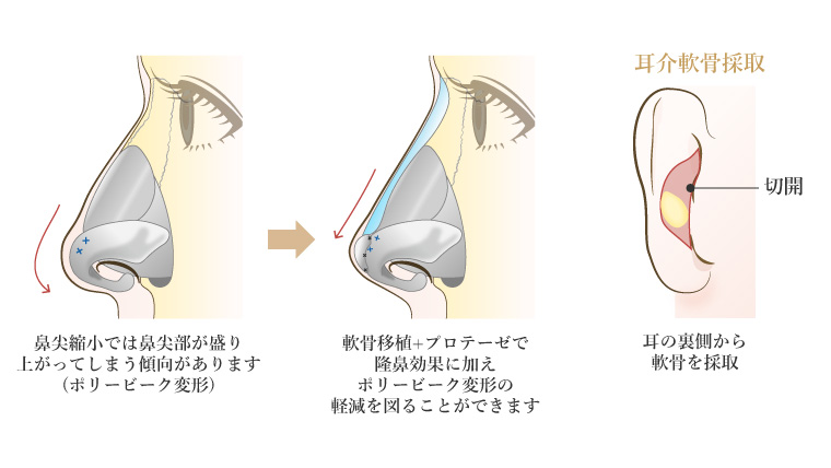 鼻尖形成の応用