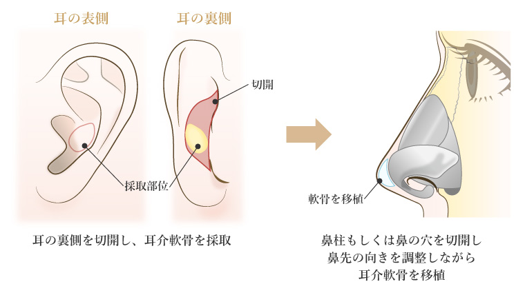 耳介軟骨移植