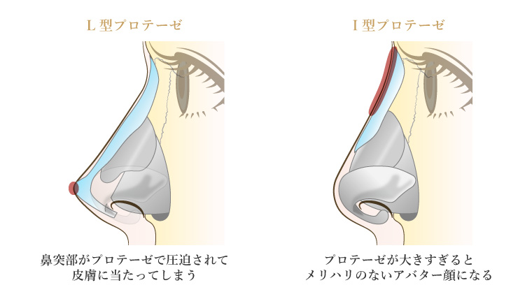 隆鼻術の問題点