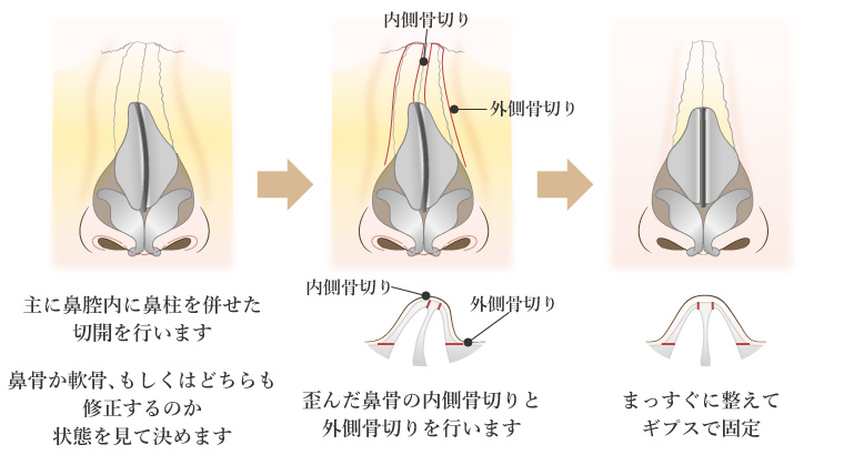 斜鼻修正