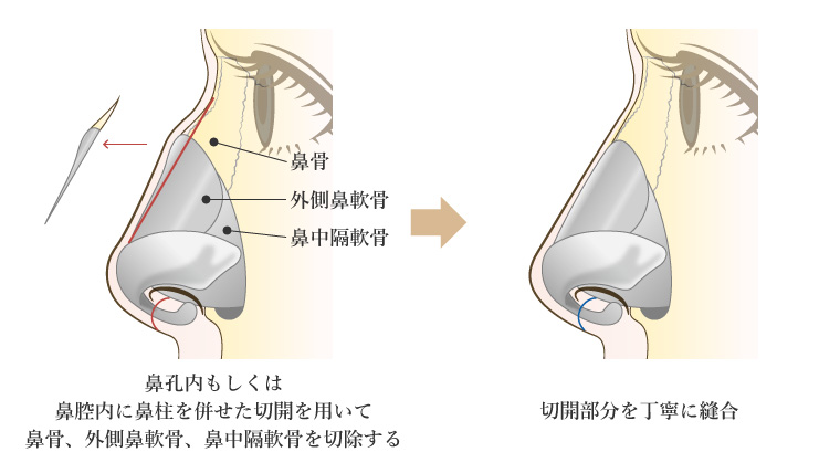 わし鼻修正