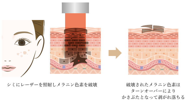 レーザー治療