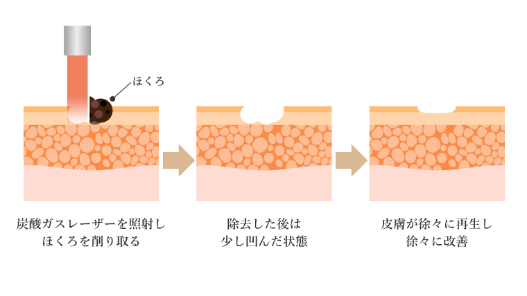 ほくろ切除