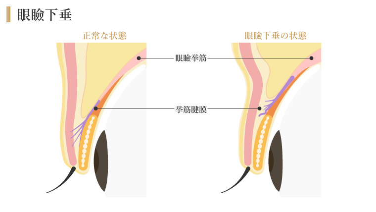 眼瞼下垂