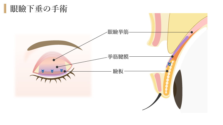 眼瞼下垂の手術