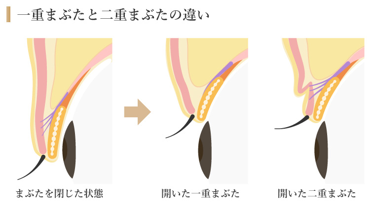 一重まぶたと二重まぶたの違い