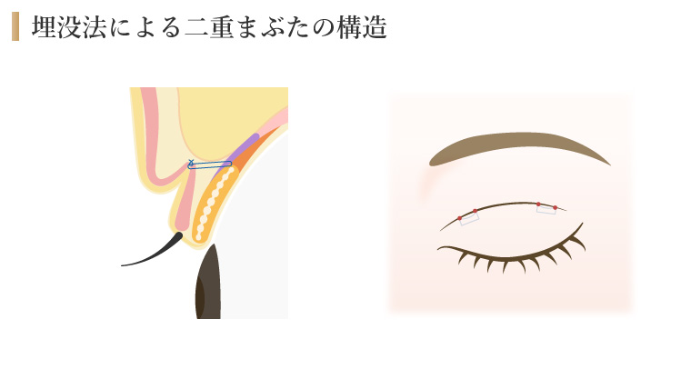 埋没法による二重まぶたの構造