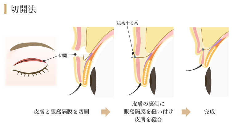 二重切開法