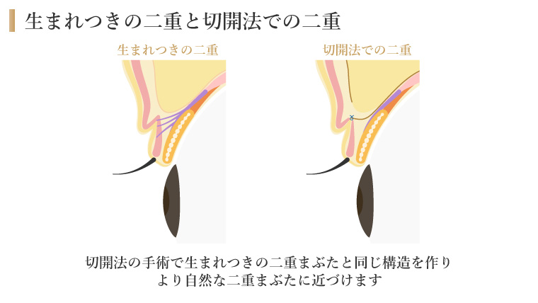 生まれつきの二重と切開法での二重