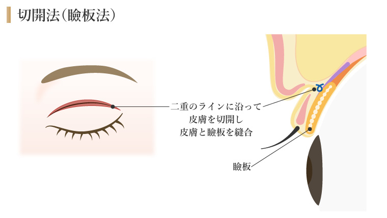 切開法(瞼板法)