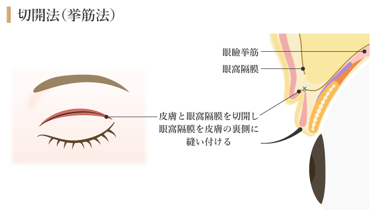 切開法(挙筋法)