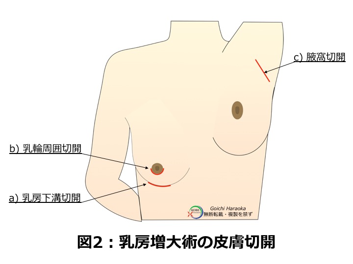 劣化 豊胸