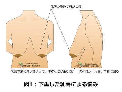 下垂した乳房による悩み