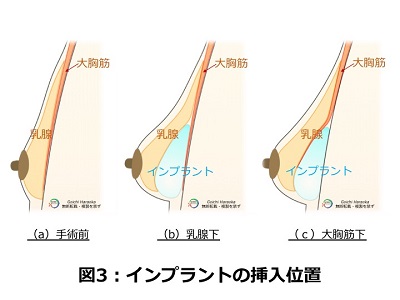 インプラントの挿入位置