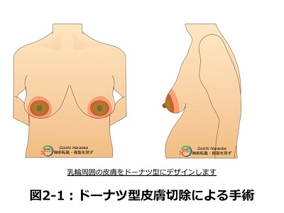 ドーナツ型皮膚切除による手術