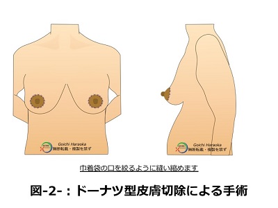 ドーナツ型皮膚切除による手術