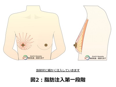 脂肪注入第一段階