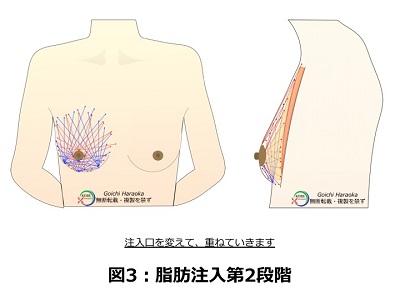 脂肪注入第2段階