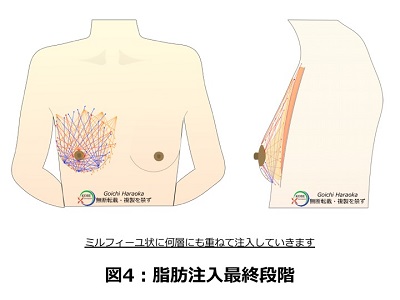 脂肪注入最終段階