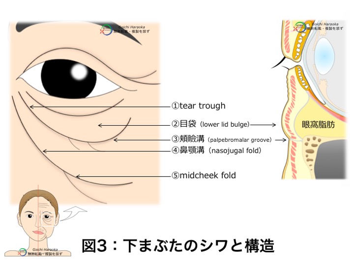 目の下のたるみ クマ シワ 神戸大学医学部附属病院 美容外科 Kobe Univercity Hospital Aethetic Surgery