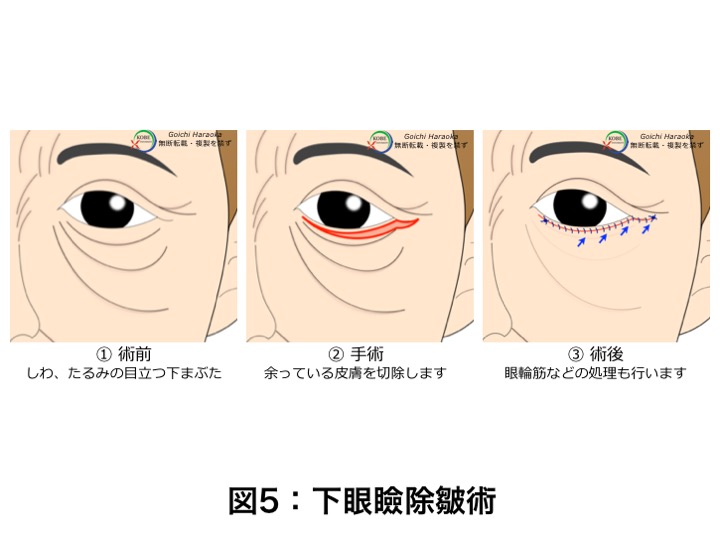 下まぶたのたるみとり 下眼瞼除皺術 神戸大学医学部附属病院 美容外科 Kobe Univercity Hospital Aethetic Surgery