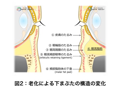 老化による下まぶたの構造の変化