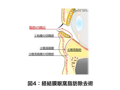 経結膜眼窩脂肪除去術