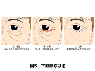 下眼瞼除皺術