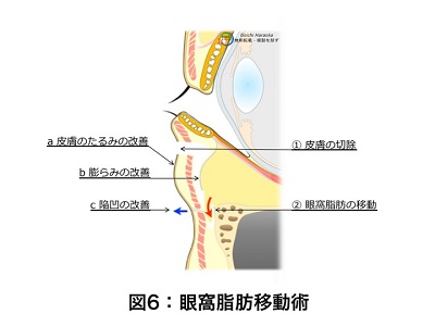 眼窩脂肪移動術