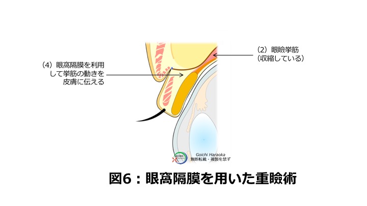 二重 埋没 切開 神戸大学医学部附属病院 美容外科 Kobe Univercity Hospital Aethetic Surgery