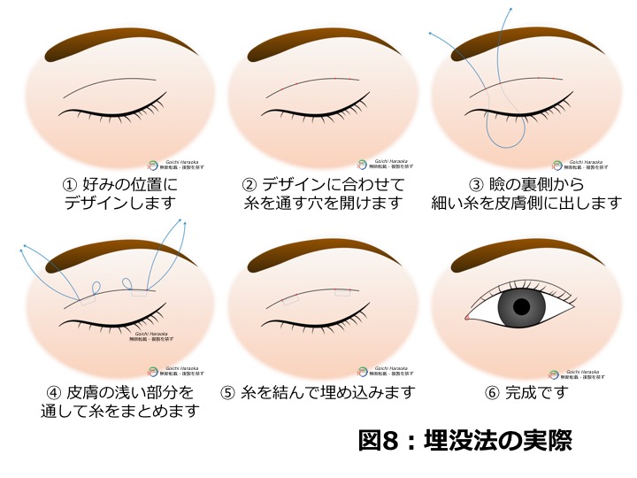 二 重 整形 埋没 とれる