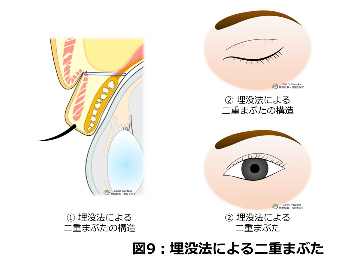 二重 埋没法 神戸大学医学部附属病院 美容外科 Kobe Univercity Hospital Aethetic Surgery