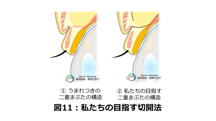 二重切開法図１１