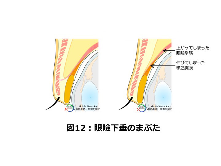 眼瞼下垂のまぶた