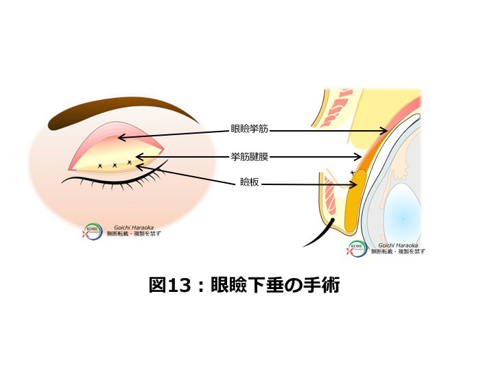 眼瞼下垂の手術
