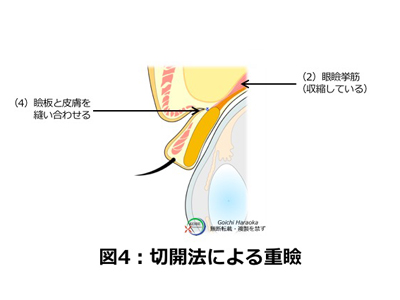 二重まぶた・瞼板法