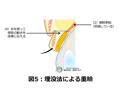 二重まぶた・挙筋法