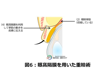 二重まぶた比較図