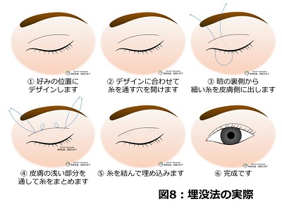 埋没法の実際