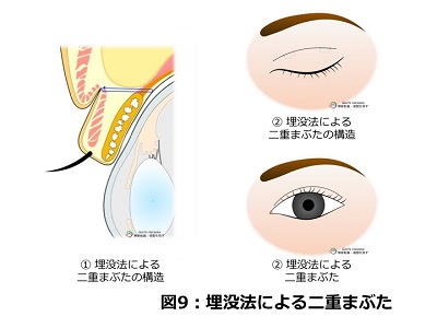 埋没法による二重まぶた